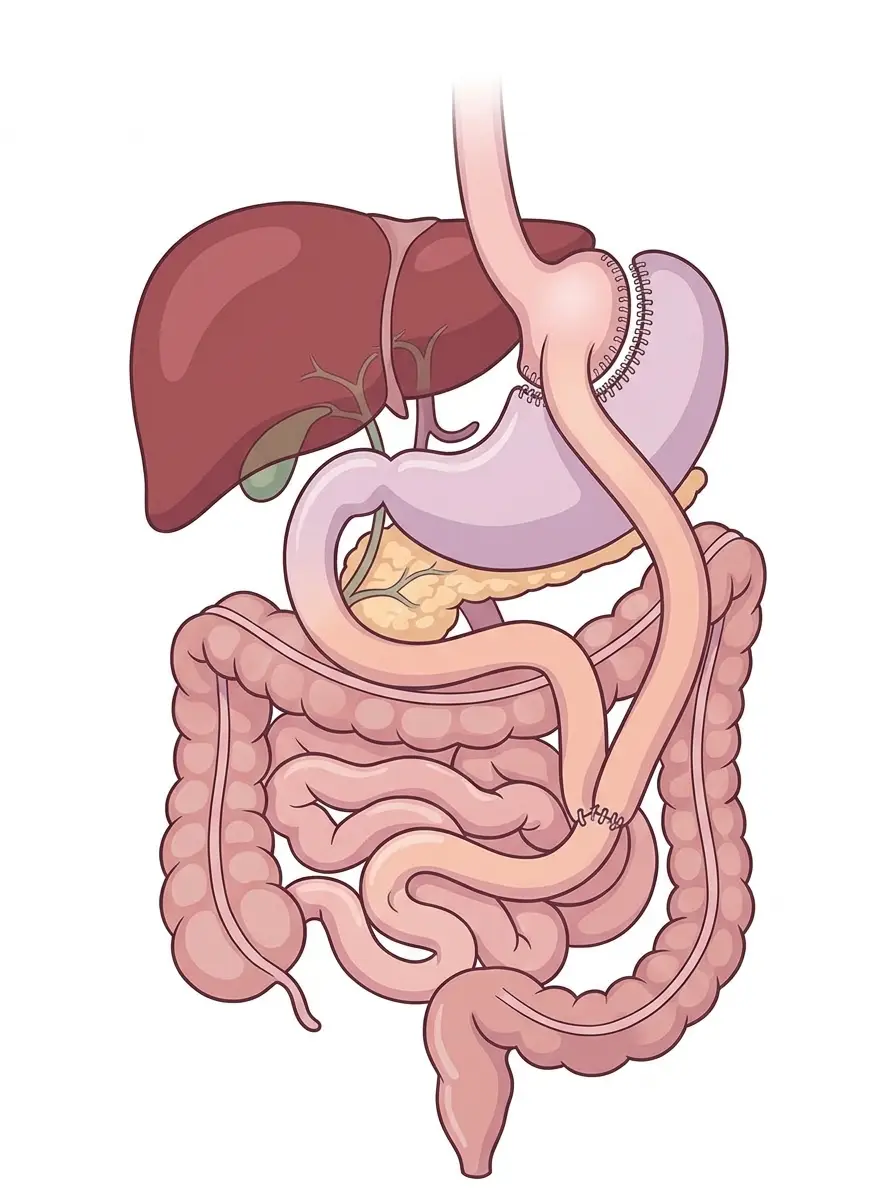 Schema del bypass gastrico: piccola tasca gastrica collegata all'intestino tenue, con lo stomaco escluso che resta in sede
