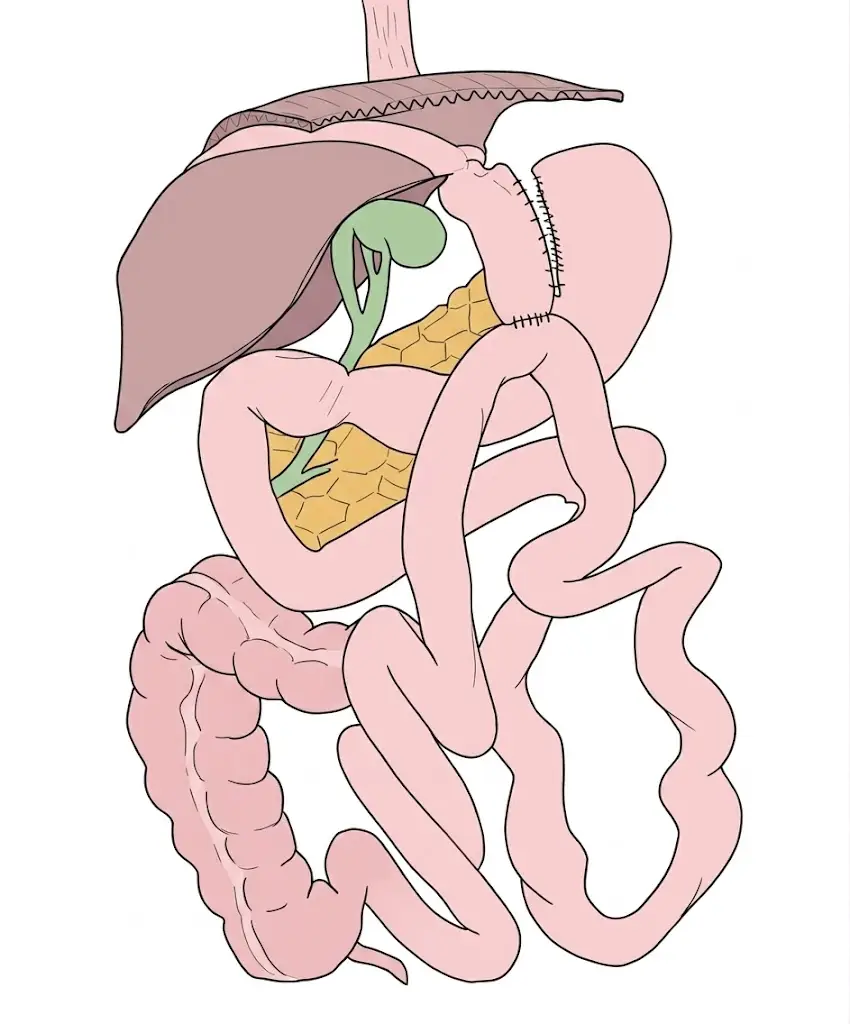 Schema del mini-bypass gastrico: tasca gastrica lunga e stretta collegata con un'unica anastomosi a un'ansa di intestino tenue