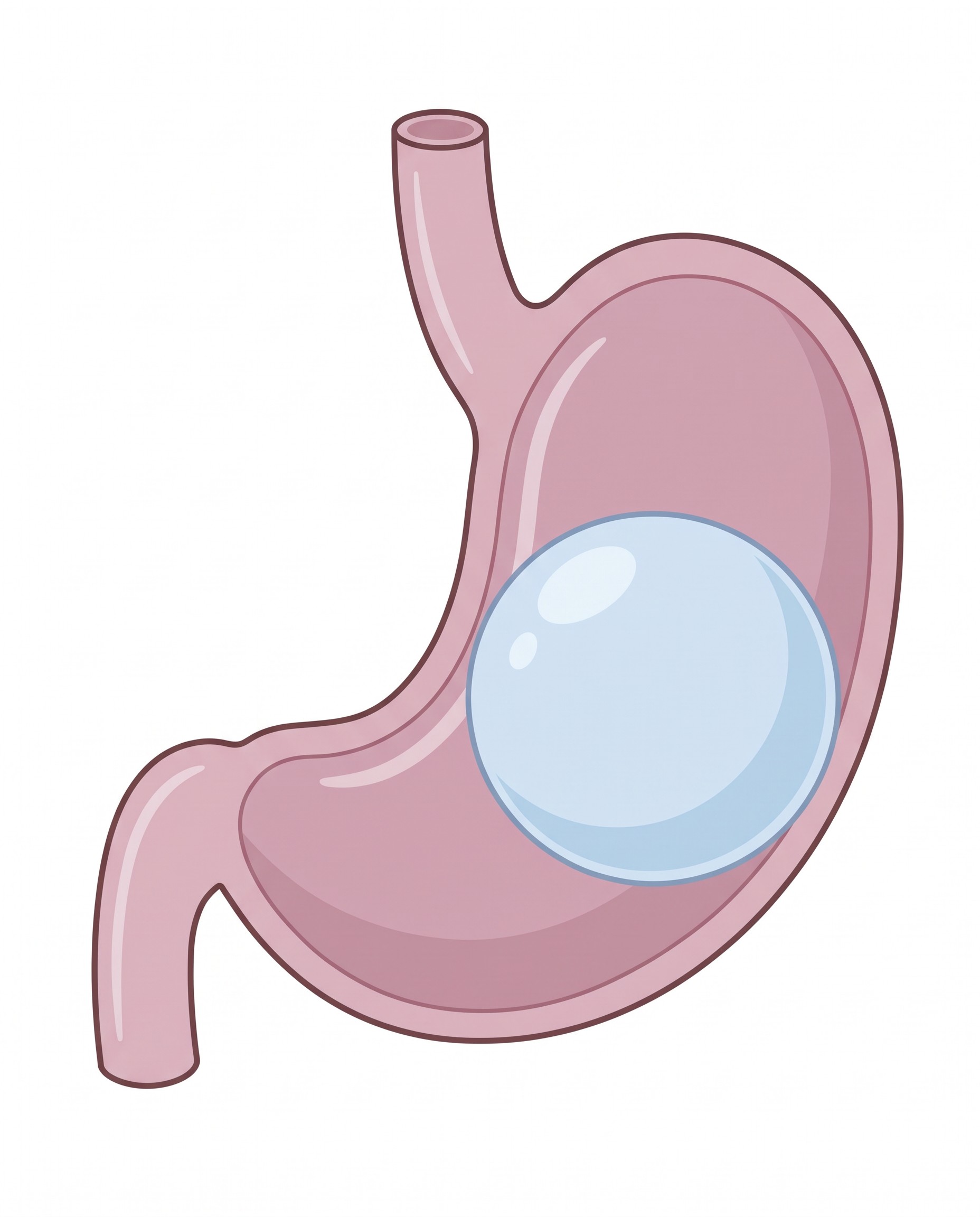 Schema del palloncino intragastrico: un pallone all'interno dello stomaco